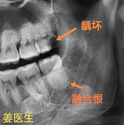 垂直阻生，小胖根。计划纵分冠根，斜了点，变成斜分冠根。