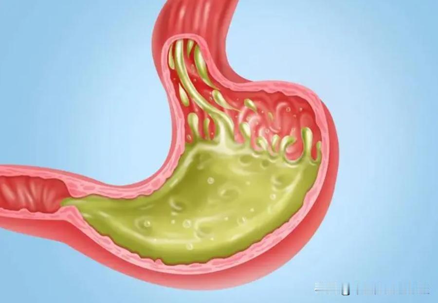 饭后总是反酸、烧心？中医教你正确的解决办法
 
反酸、烧心是由胃、十二指肠内容物