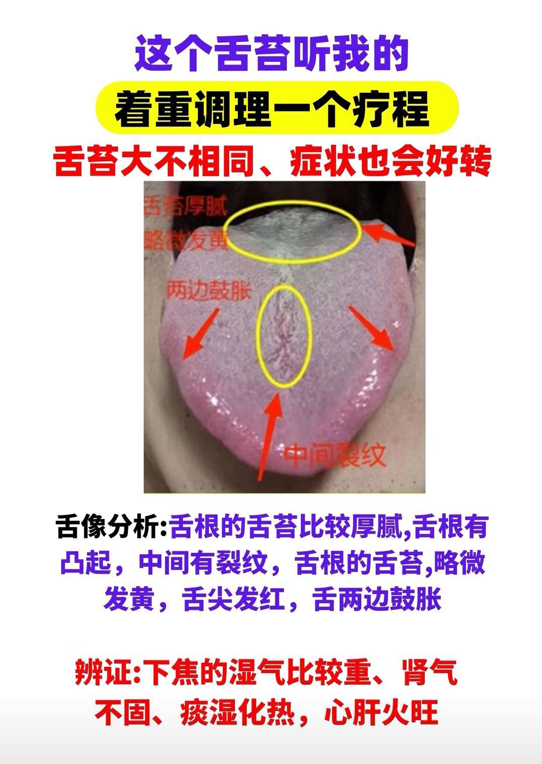 这个舌苔听我的 着重调理一个疗程 舌苔大不相同 症状也会好转