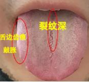 热邪侵筋，疲软无力，只知道健脾补肾，吃再多药也无用！
 
患者主诉：举而不坚，难