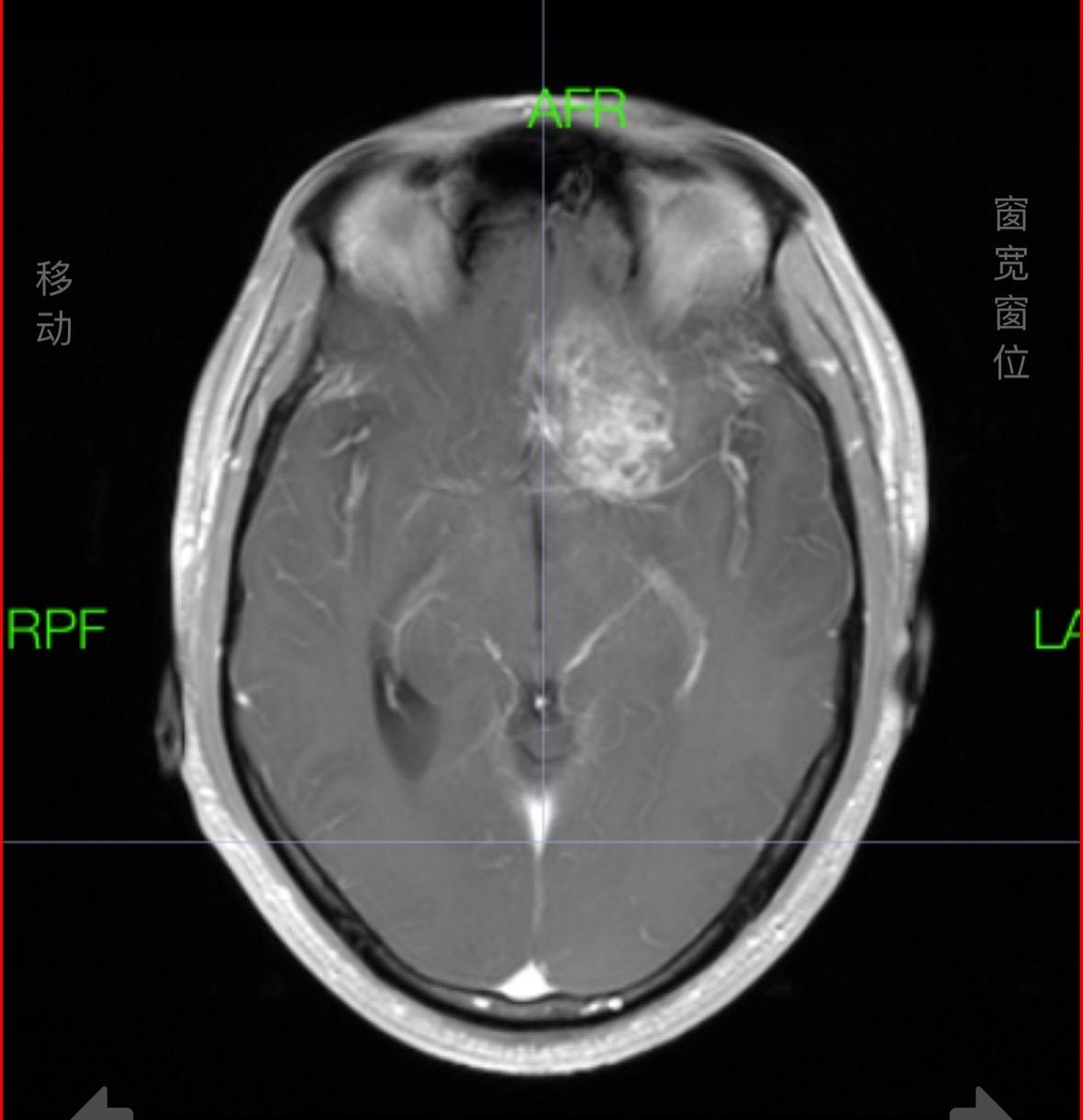 掩盖牙痛的手术。这个肿瘤，周边的重要结构实在太多了，连前交通复合体、内囊前肢、下丘脑、脑室壁、尾状核、中动脉等都一一暴露，如刀尖上行走，手术中导航加持，术中磁共振如同老师一般给你阅卷打分，没想到术中的专注还有意想不到的效果，因为做手术前牙痛，没想到都因为专注做完手术还好了点，看来没入错行，一举两得！