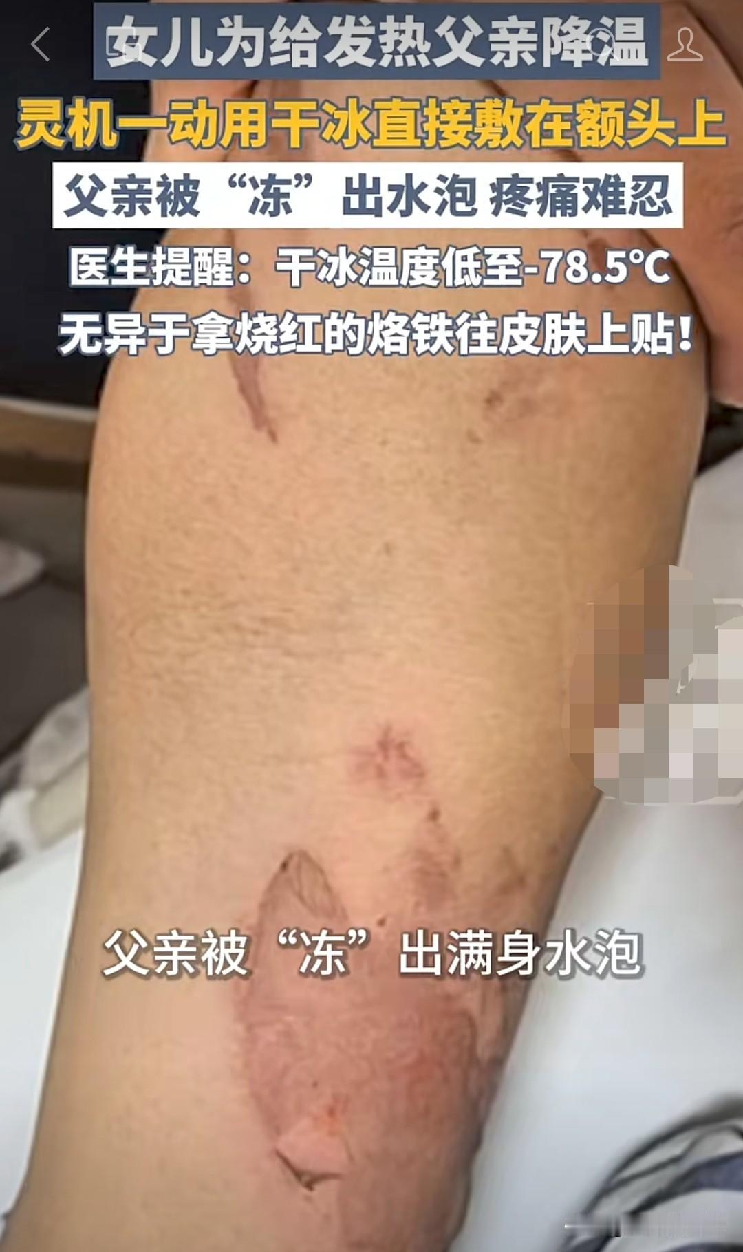 千万别乱降温！女儿好心给发烧父亲敷干冰，结果冻出满身水泡
 
刚刚看到一个让人又