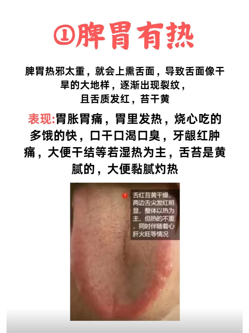 观舌象，看脾胃，这四种舌象你是哪种？