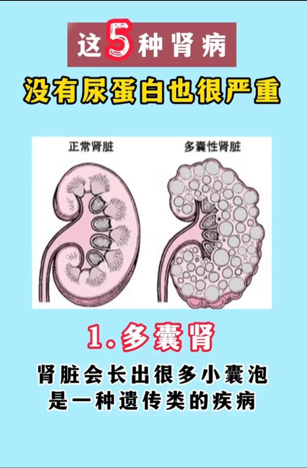 当心!这5种肾病没有尿蛋白也很严重!
第1种是多囊肾:肾脏会长出很多小囊泡。这是一种遗传类的疾病。
第2种是高血压肾病:高血压会使得血管内的血液压力增高，从而导致蛋白漏到尿液里。
第3种是药物性肾损伤:肾毒性的药物引起的尿蛋白并不是特别高。最常见的就是肾动脉
第4种是缺血性肾脏病:的粥样硬化，这会使得肾脏缺血缺氧，肾功能下降。
第5种是高尿酸肾病:尿酸太高，尿酸结晶就会沉积，进而导致尿酸性肾病。