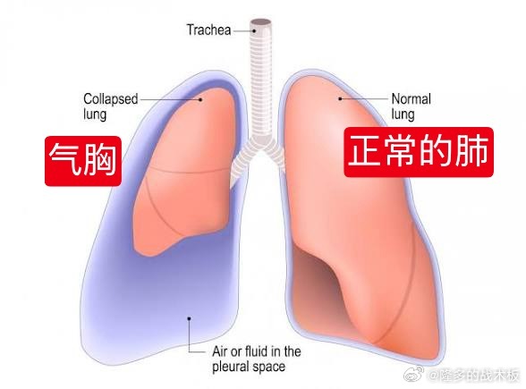 气胸通常是指肺部表面有破口，导致空气从肺里漏到胸腔里，挤压到肺，因此无法正常换气