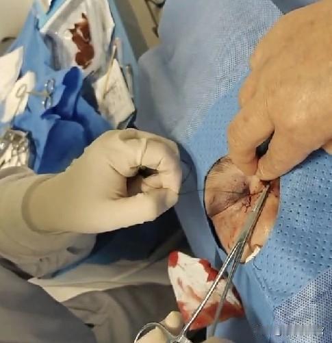 老公无证骑电摩未戴盔，撞违停货车致脑出血+面部缝针！女儿要请律师，该听吗？
 