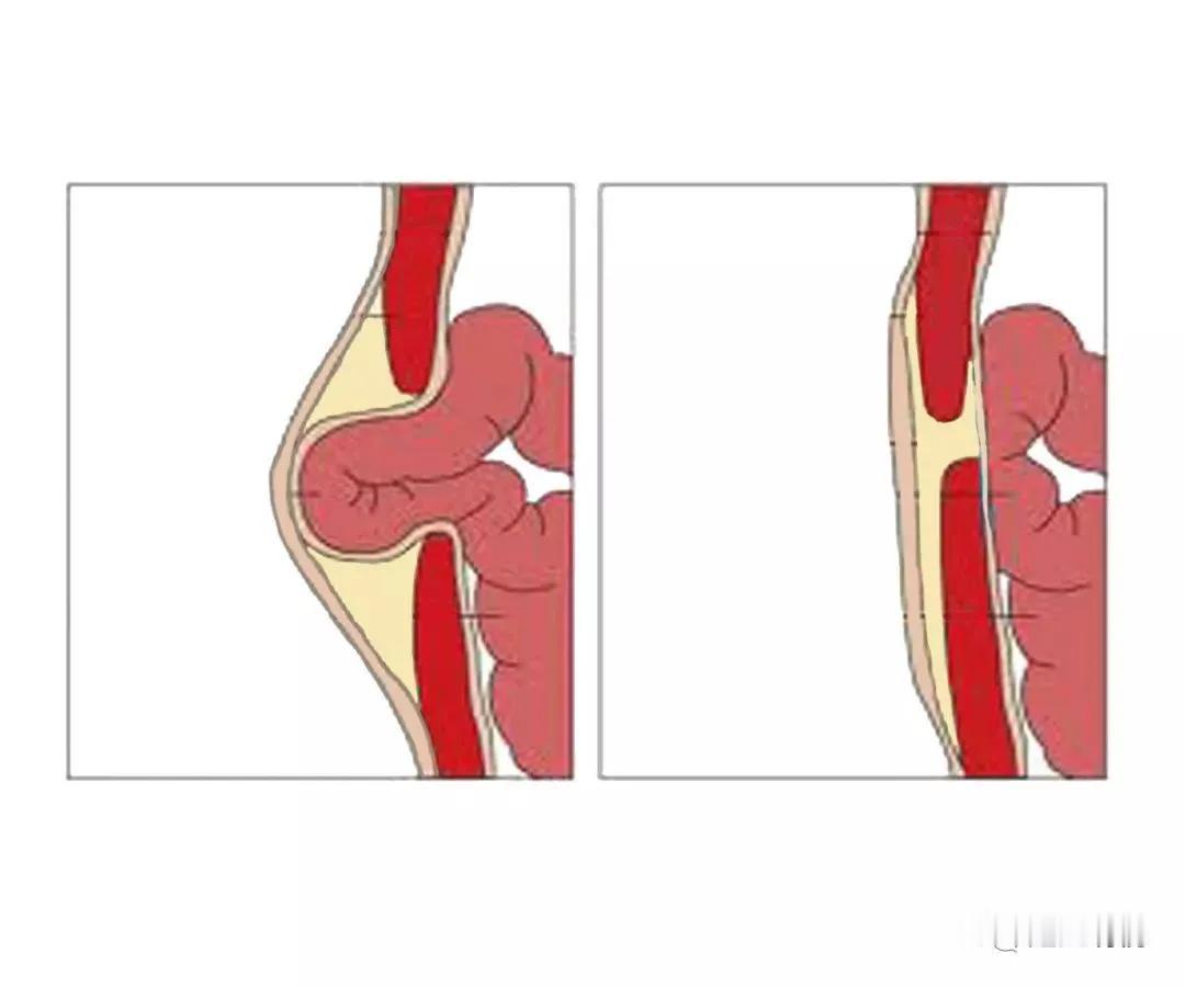 脐疝的示意图，大家可以看看。