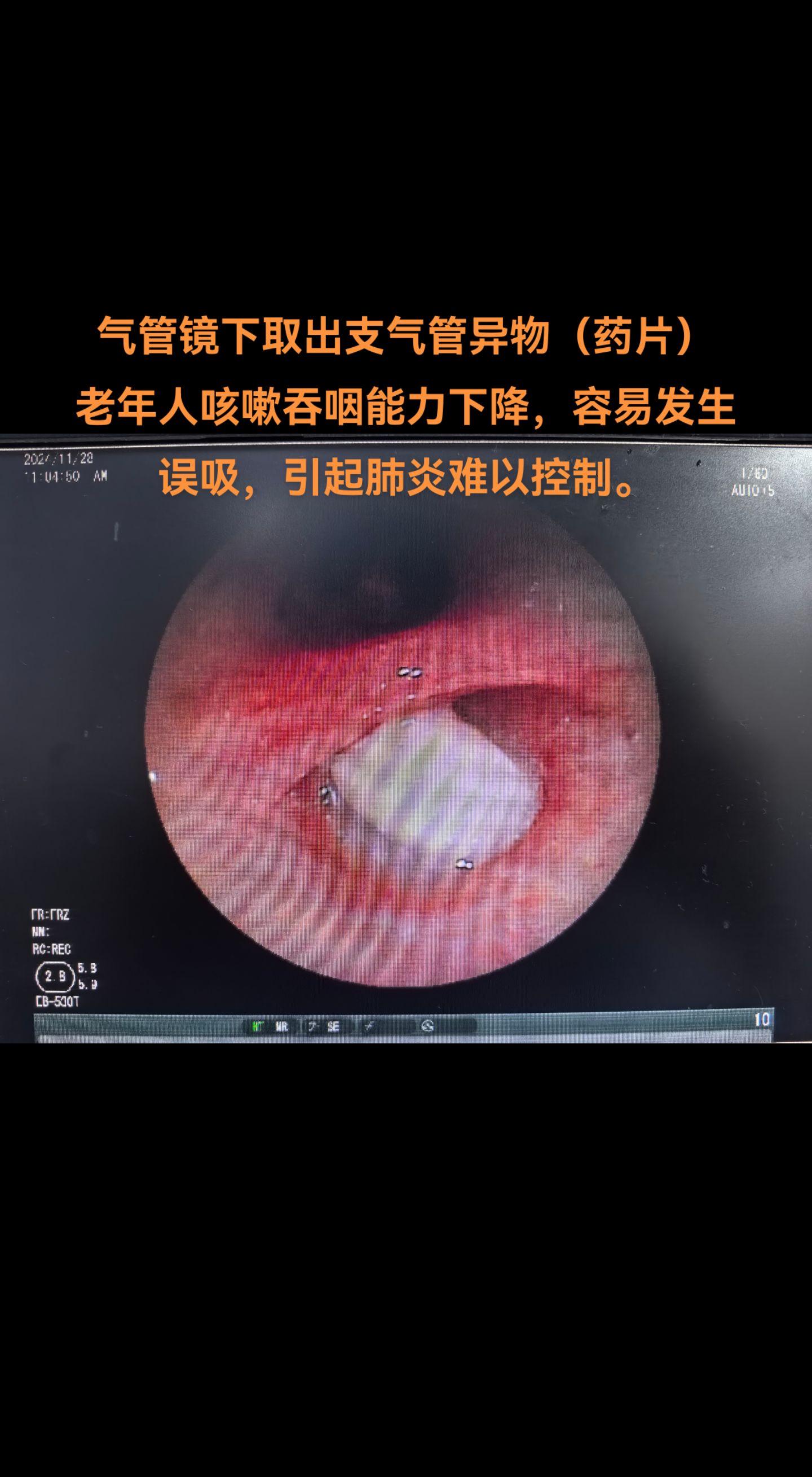 气管镜下取出支气管异物。咳嗽吞咽能力下降，容易发生误吸导致肺炎，老年人吃饭服药切