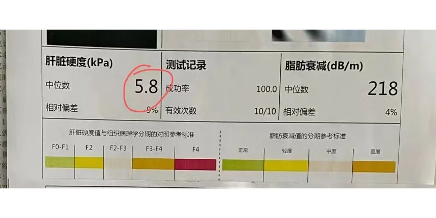 肝弹常作为评估肝硬化程度的指标，但是对于肝病患者来说，单独一项指标对于...