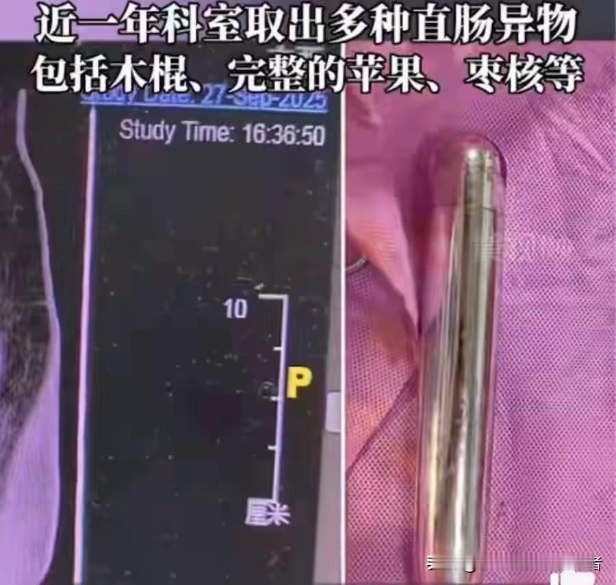 玩的真嗨
40岁男子把长约30厘米的金属棍子插入肛门，导致
无法排出。他也试着排