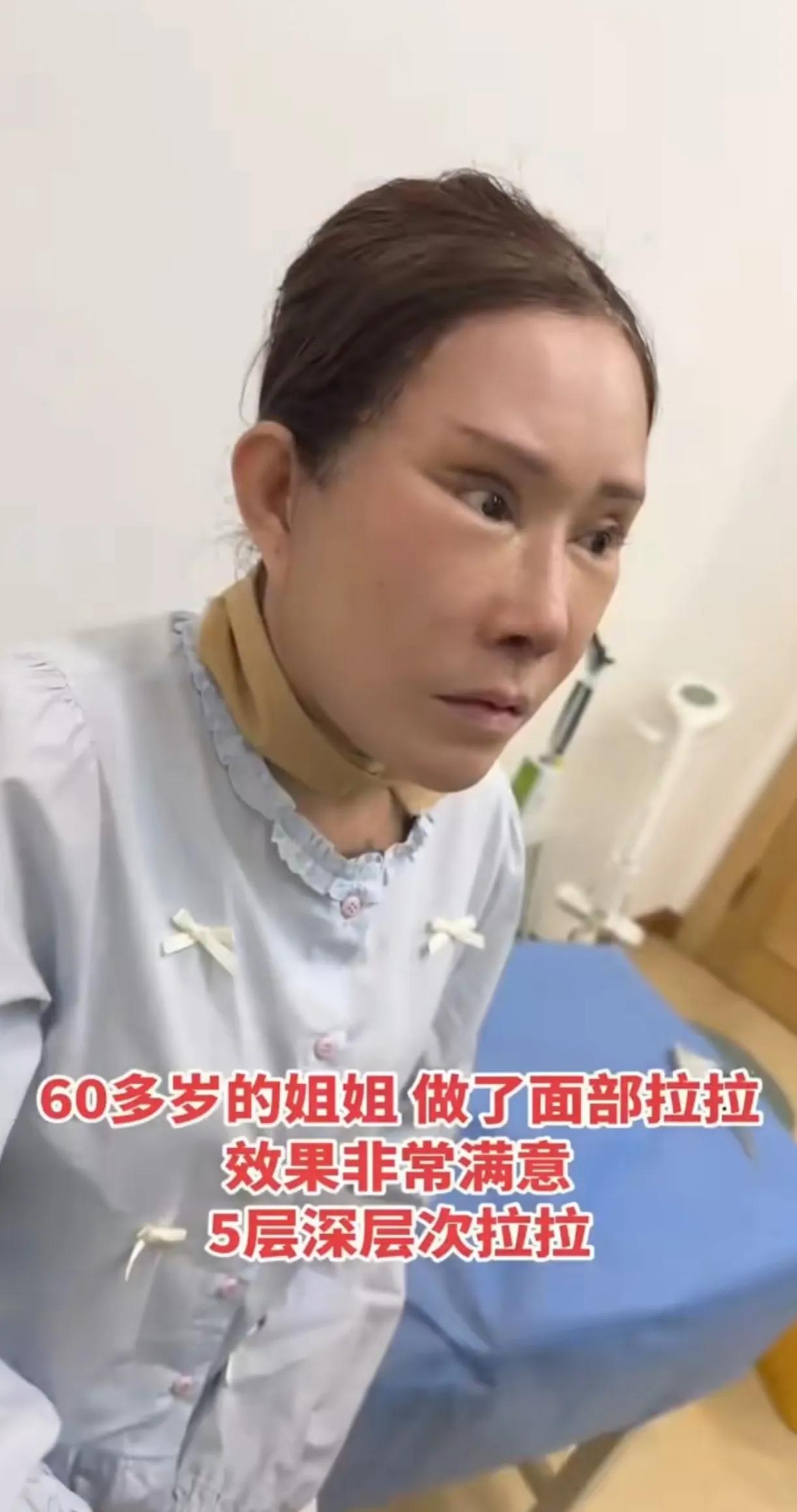 60多岁的大姐，为了更年轻漂亮，做了面部提拉，割了双眼皮，脸上看不到一点皱纹，都