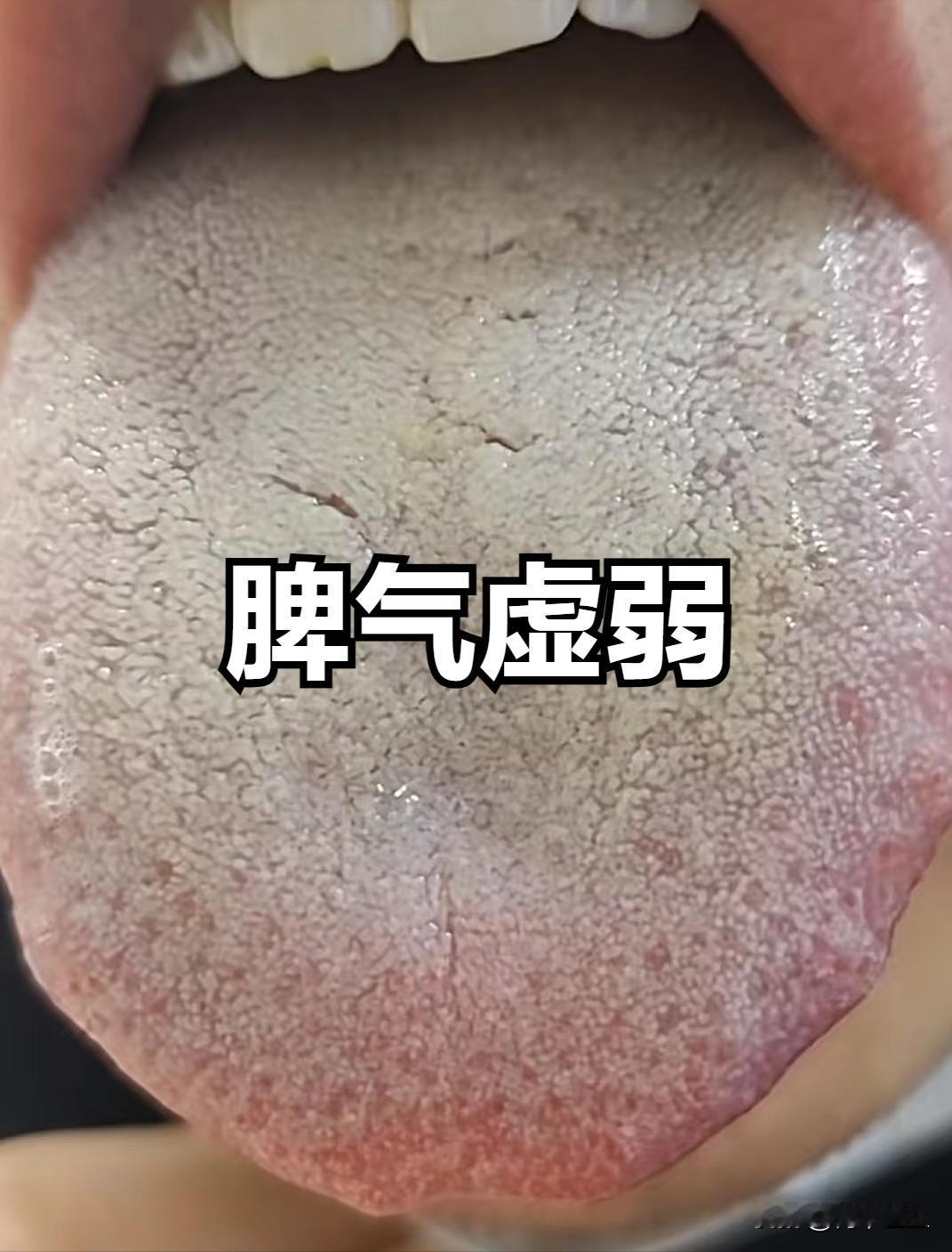 今日舌诊总结

（一）脾气虚弱，湿气化热

症状：神疲力乏，嗜睡，尤其在饭后更为