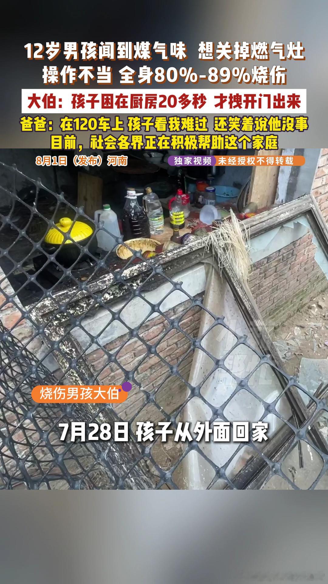 12岁男孩闻到煤气味关阀门时被烧伤全身烧伤八九成，这个程度真的太严重了，后期恢复