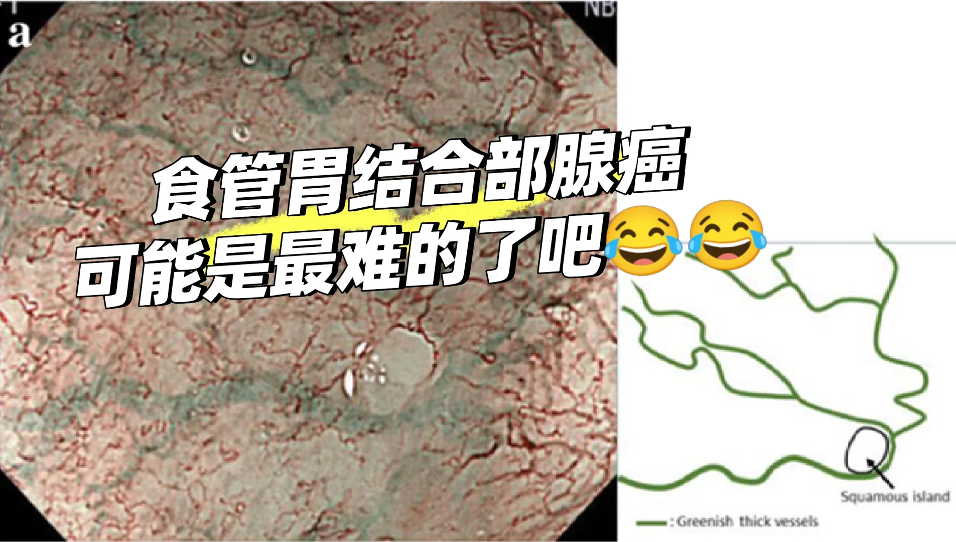 Barrett巴雷特食管到食管腺癌