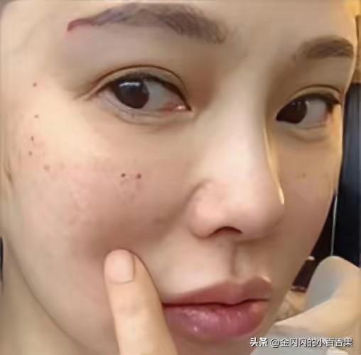 伊能静“真诚不装”最多只能延缓衰老，不能逆转衰老。”看看她满眼的针孔，只能说岁月