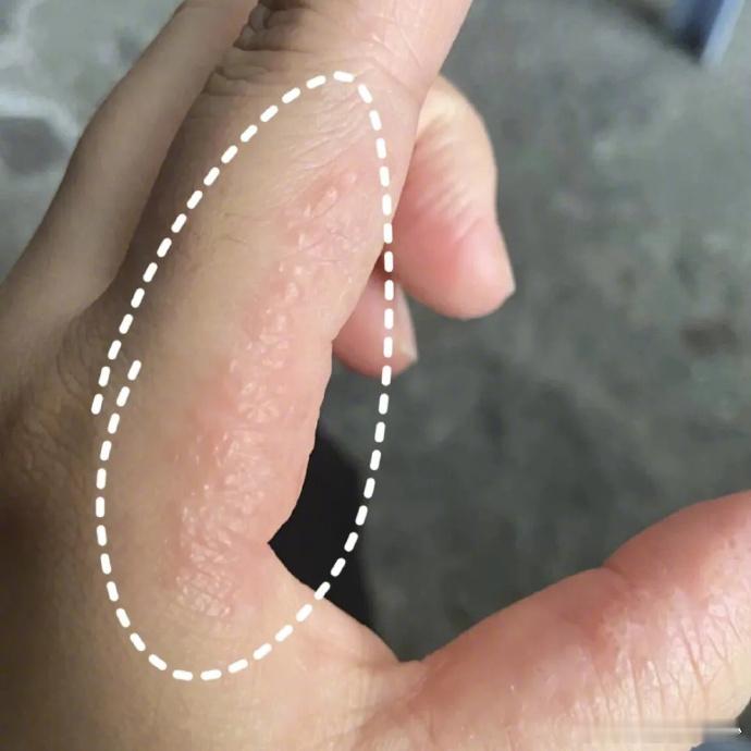 【夏天手上的小水泡是什么】湖南儿童如何预防手足口病 每到夏天，不少人的手指、手掌