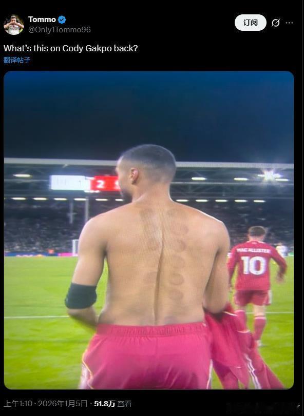 真有球迷问，加克波这是啥东西在身上结果很多国外推都解答：这是拔罐疗法，能排出体内