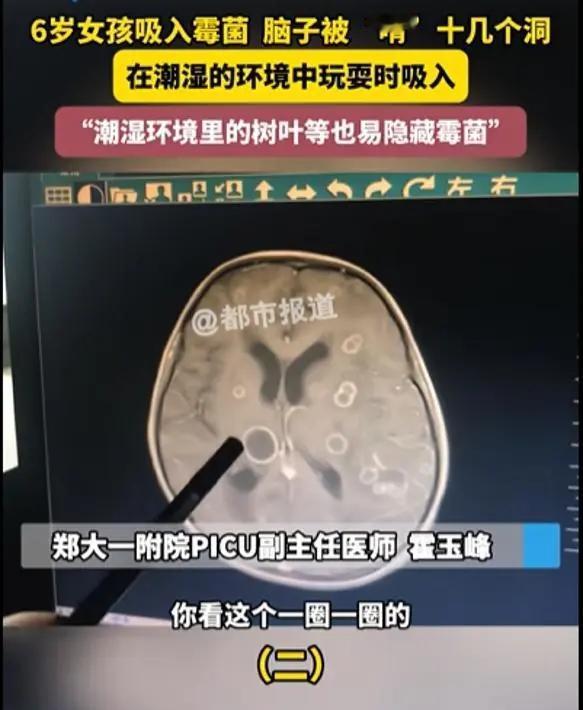 太可怕了！
河南一个才6岁的小女孩，连续发烧17天，后来连意识都不清了，赶紧转到