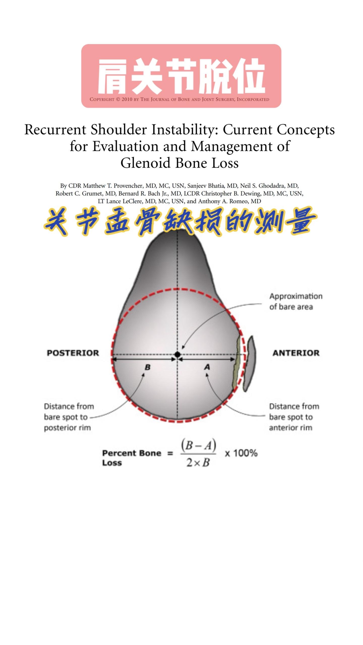 关节盂骨缺损的测量。肩胛盂缺损