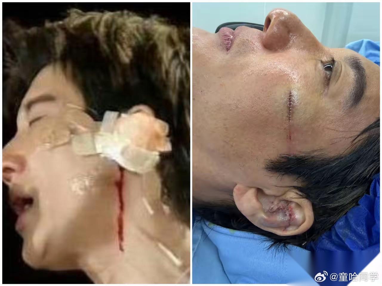 王力宏演唱会受伤缝了39针 会不会留疤我不知道 但是我看出来了，他伤口缝合的这针