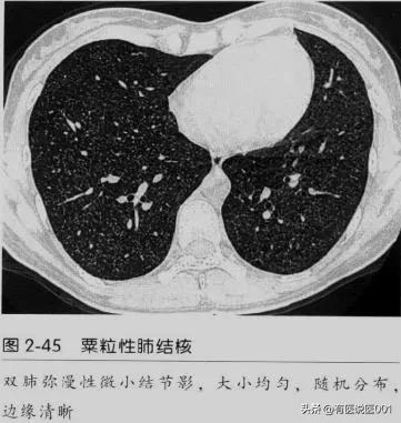 肺结核：探究其严重性、传染性及治疗方法

在当今社会，肺结核作为一种古老的疾病，