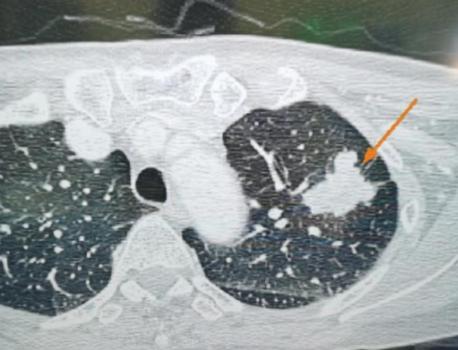 别让“癌”字吓退生路，早期肺癌微创手术，真没那么可怕！前阵子接诊了一位60多岁的