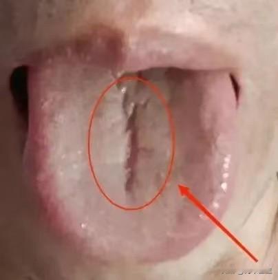 别看见个齿痕舌就健脾，有些是肝的原因，你去健脾完全是在火里加柴，没用，还越来越糟