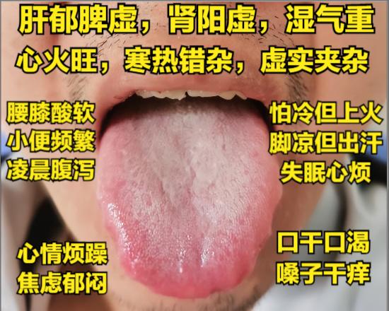 今天不咋忙，继续挑战分析88个舌象！只要看到，都会分析！[灵光一闪][灵光一闪]