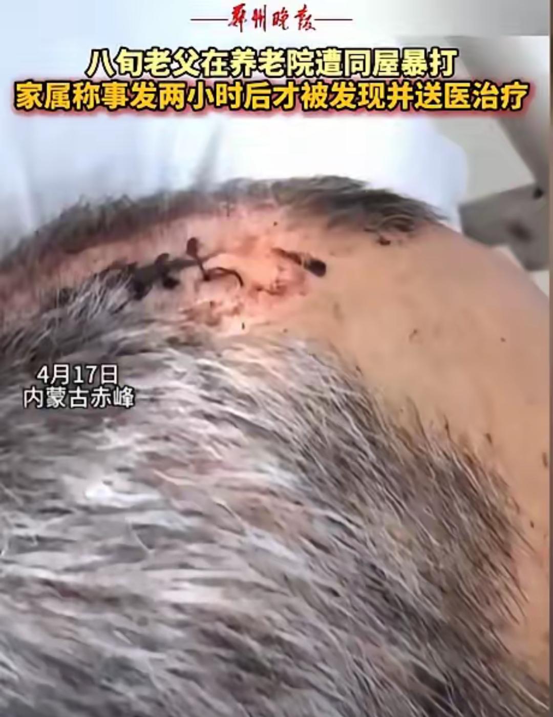 养老院里的那一棍子，打断的是信任。

家属离开才几天，老人就满身是伤，裤子裂到裤