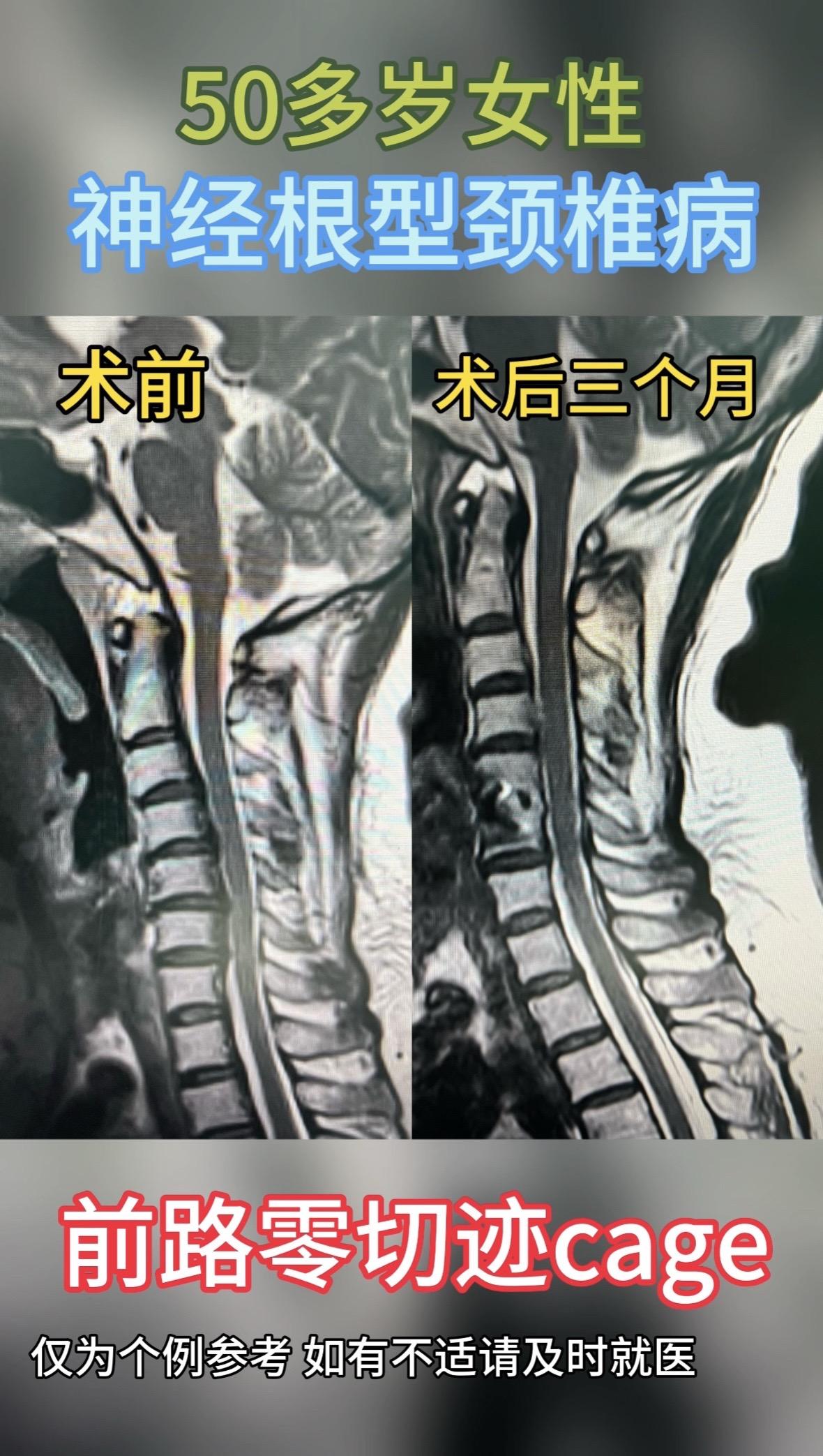 50多岁女性，神经根型颈椎病，前路零切迹cage，术后3月复查，症状大...