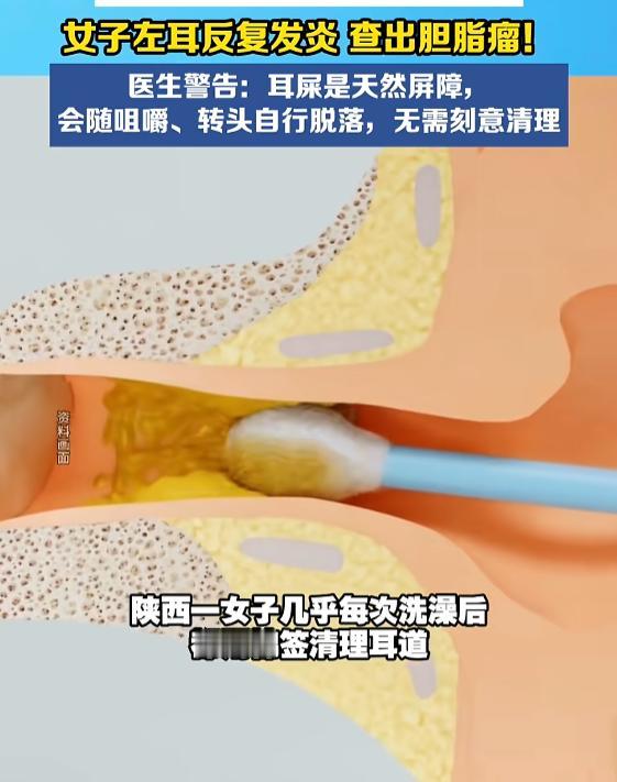 “过度清洁惹的祸！”9月13日报道，陕西，一女子每次洗澡后，都会用棉签掏耳朵，这