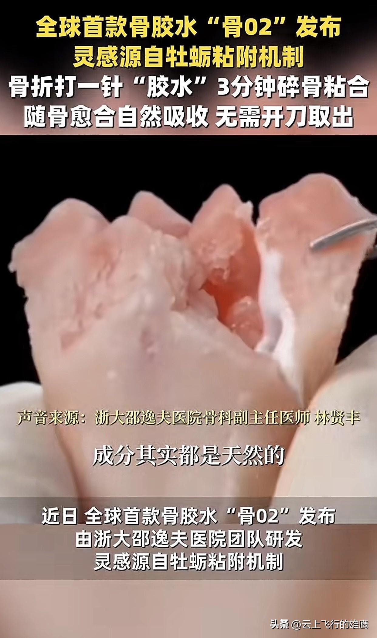这下想不出名都不行了
全世界都知道了

万万没料到！浙江邵逸夫医院研发出全球首款