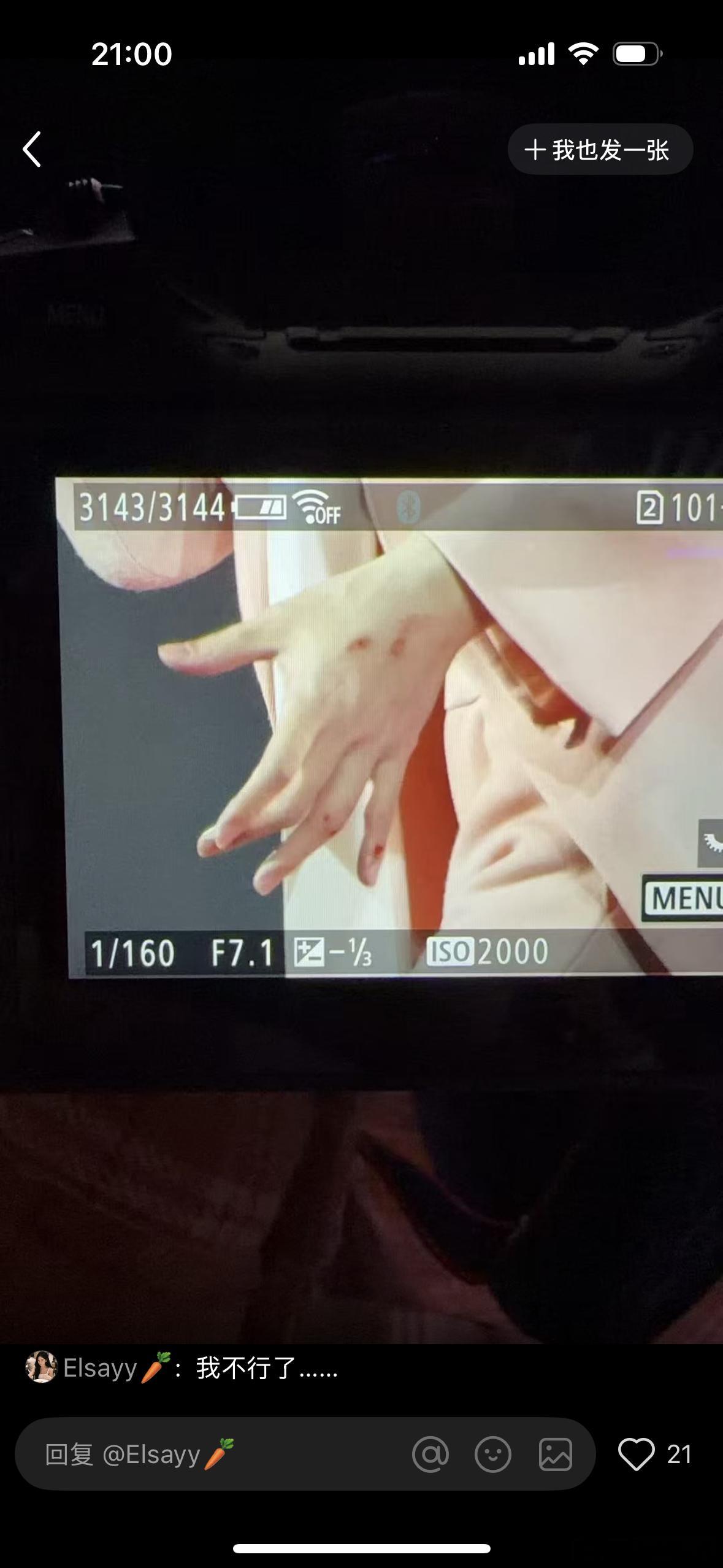 阿信手受伤了玩什么 