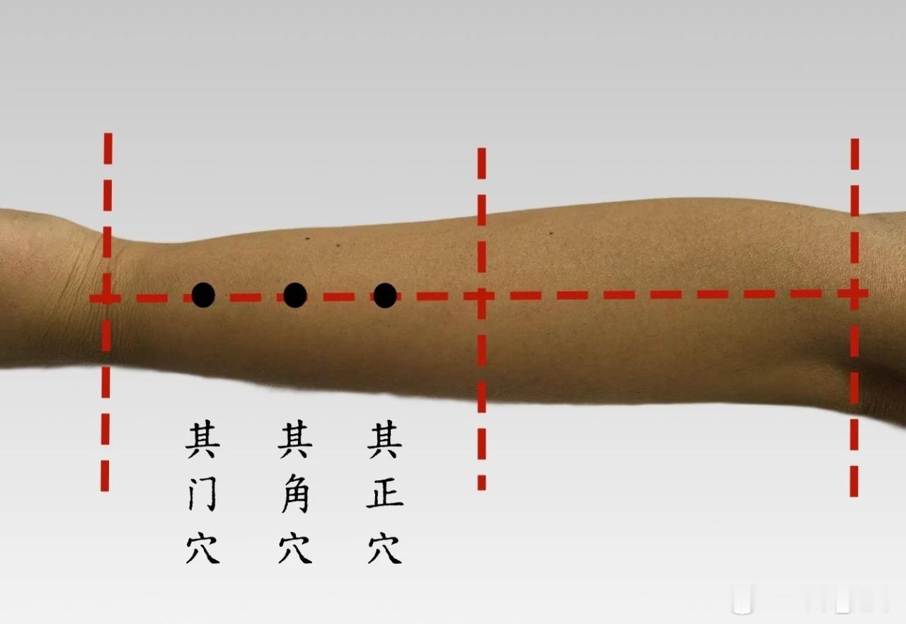 有“痔”青年的福音，其门穴、其角穴、其正穴 三其穴源自董氏奇穴 位置：手臂侧放，