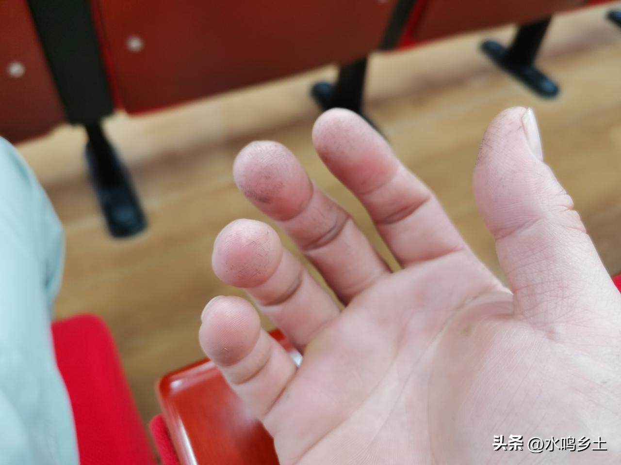 去骨科医院学习，当我签到签字时，我发现不少医生盯着我的手看，手指头都是裂痕，手掌