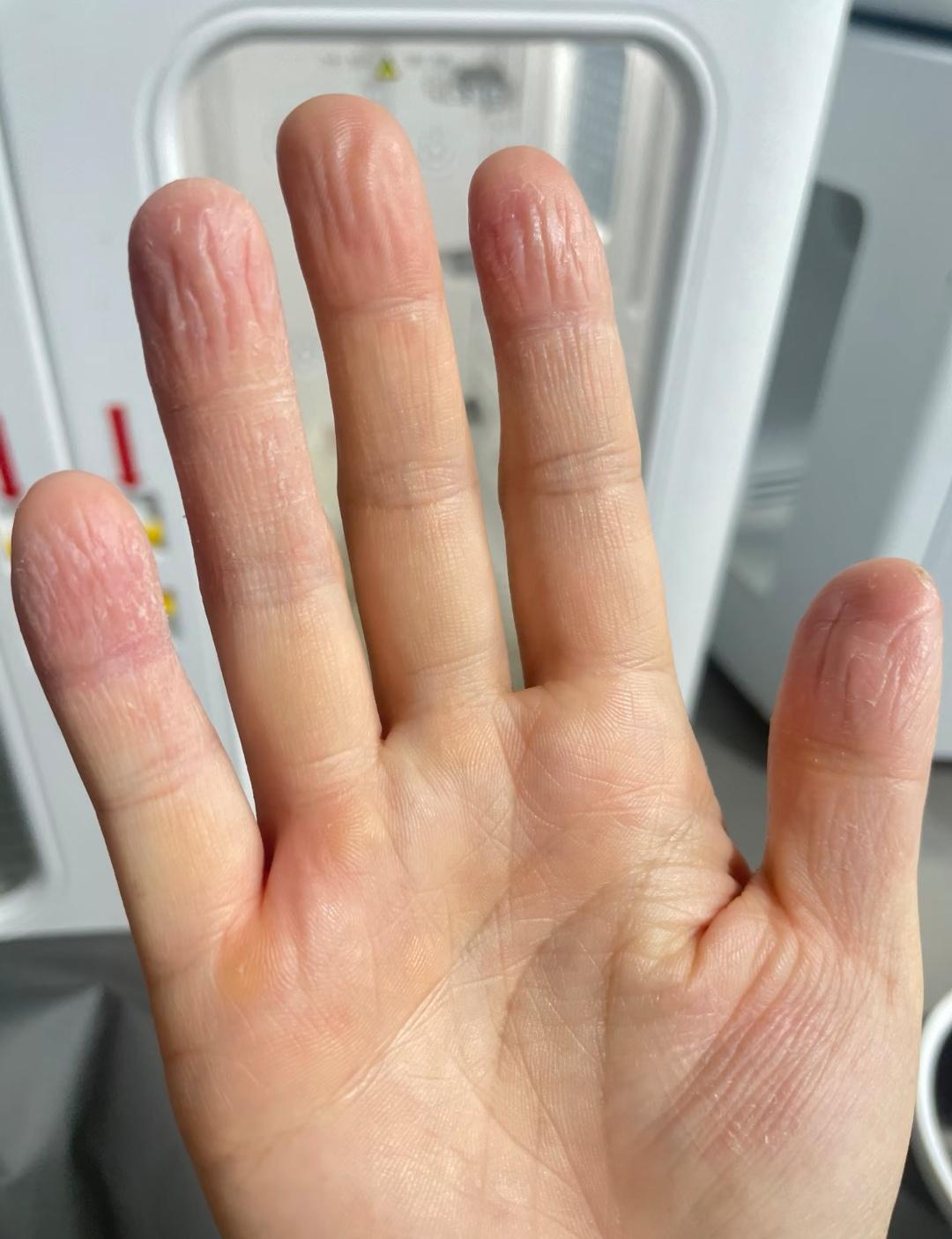 我想装指纹锁，师傅告诉我这辈子都不要想了。手指皮肤常年脱皮起皱，纹路全部模糊，录