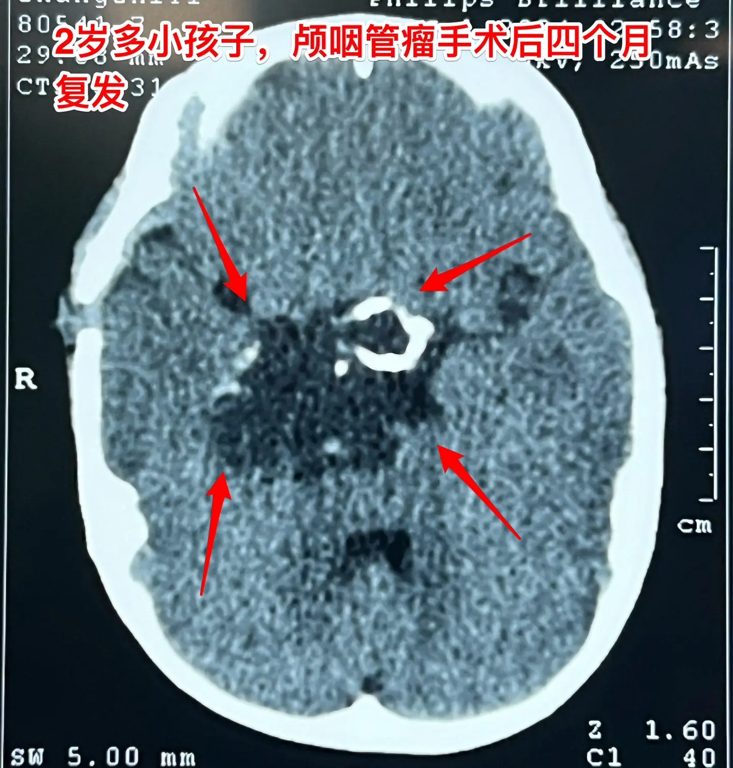 2岁孩子颅咽管瘤复发不得不接受手术。2岁多的山东女孩子，在颅咽管瘤手术...