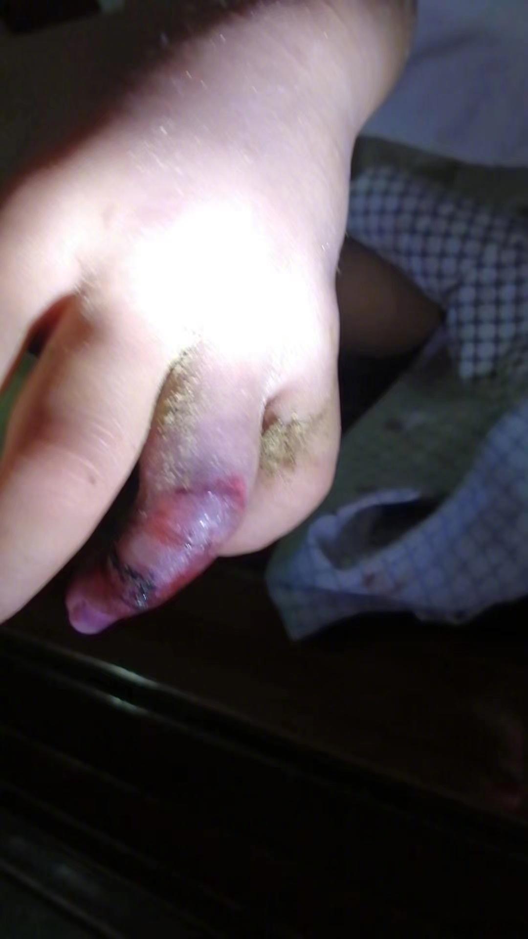 常见毒蛇为前沟牙或者中空管牙，都为并排两颗牙，蛇牙折断了还可以再生，所以毒蛇咬伤