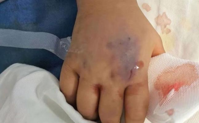 【云南一3岁女童被毒蛇咬死3天后奇迹生还】
“孩子醒了！她能动了！”近日，在广西