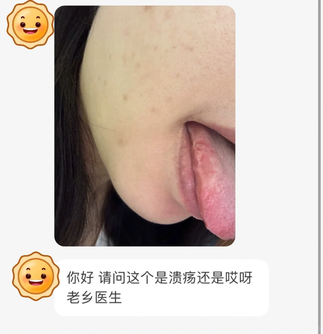 怎么看是不是口腔溃疡？