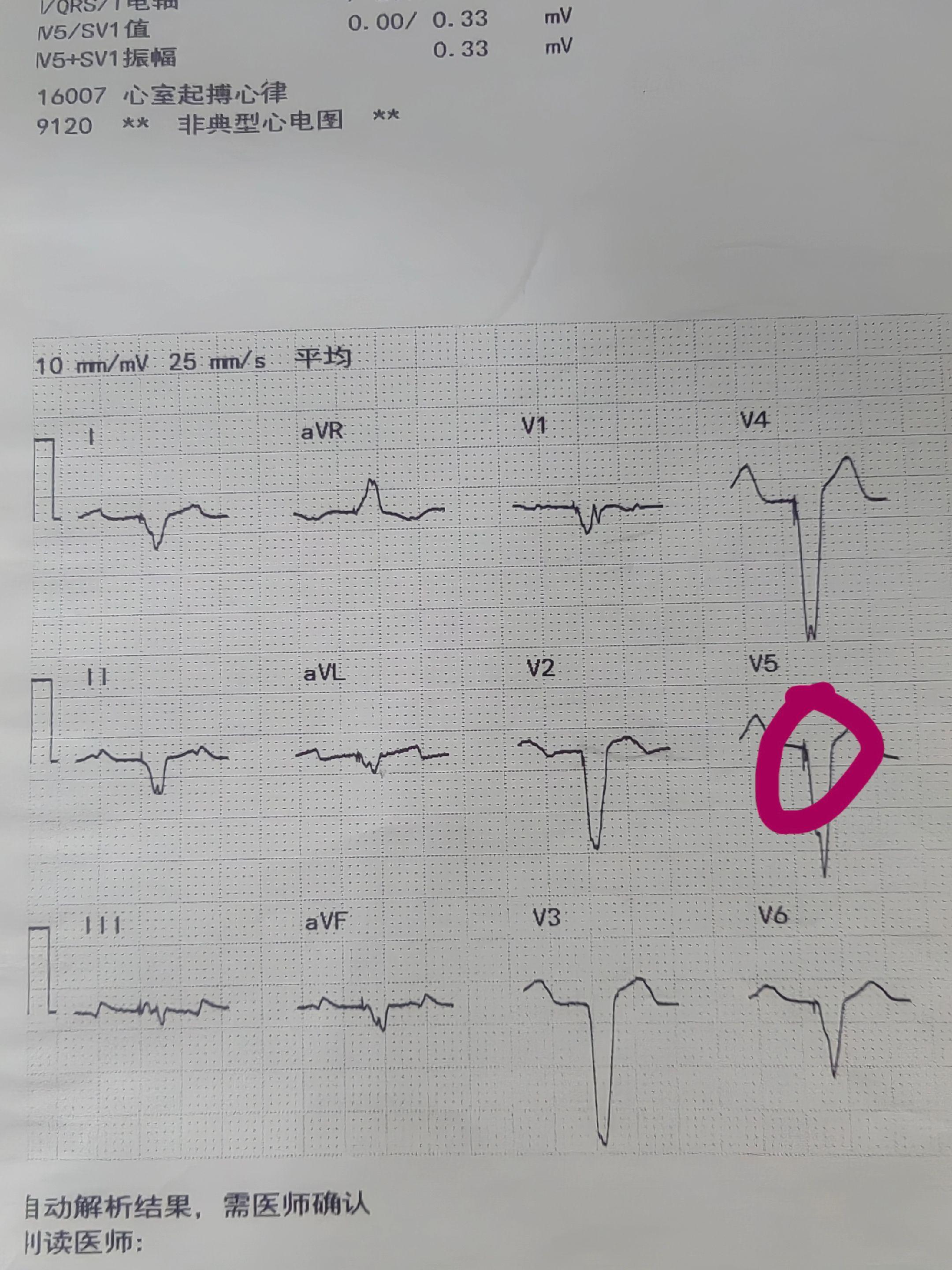 CRT三腔起搏器心电图，患者存在阵发房速，2：1传导，房速时心室起搏。