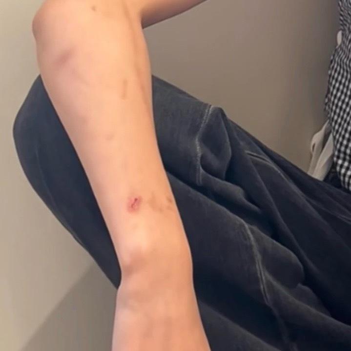 张子枫手臂好多淤青这个完全是割了一个口子哇妹妹真的没事吗 张子枫手臂又添新伤张子