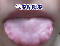 齿痕舌不全是脾虚，4种齿痕舌情况，通过舌象告诉你！[给力][给力][给力]



