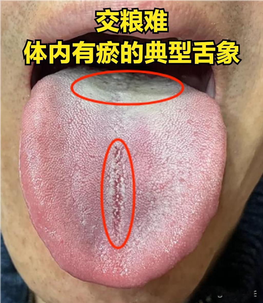 交粮快是瘀，抬头难是瘀，见花不起是瘀，三方打通宗筋气血！
先说交粮快是瘀。属于肾