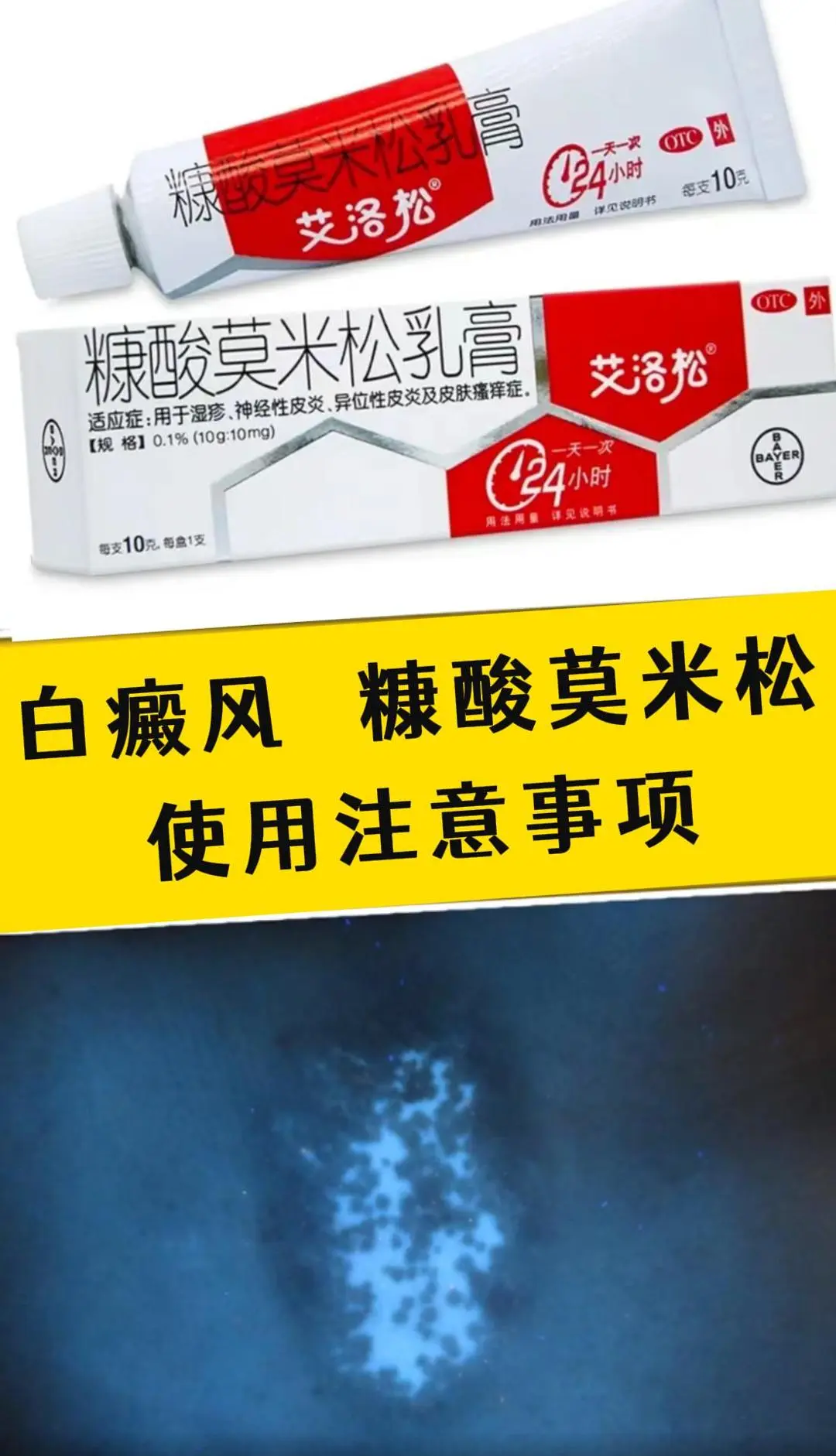 艾洛松，即糠酸莫米松，是一种弱效的激素类外用药，主要用于湿疹、神经性皮...