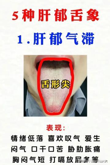 肝郁的 5 种舌象对照，看看你是哪一种