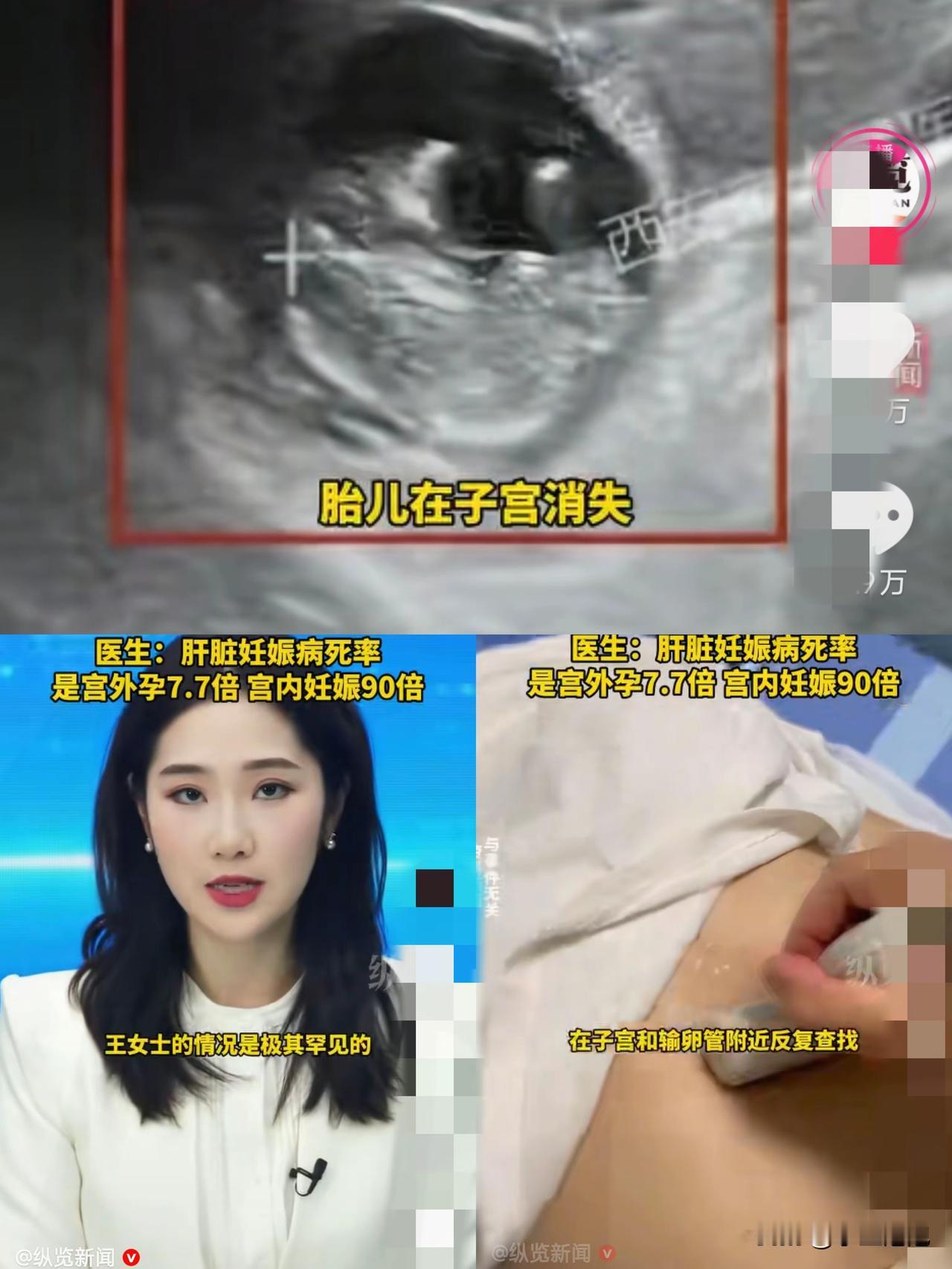 “彻底解释不清了！”40岁女子停经50天后，抽血显示怀孕，但做b超时，医生在子宫