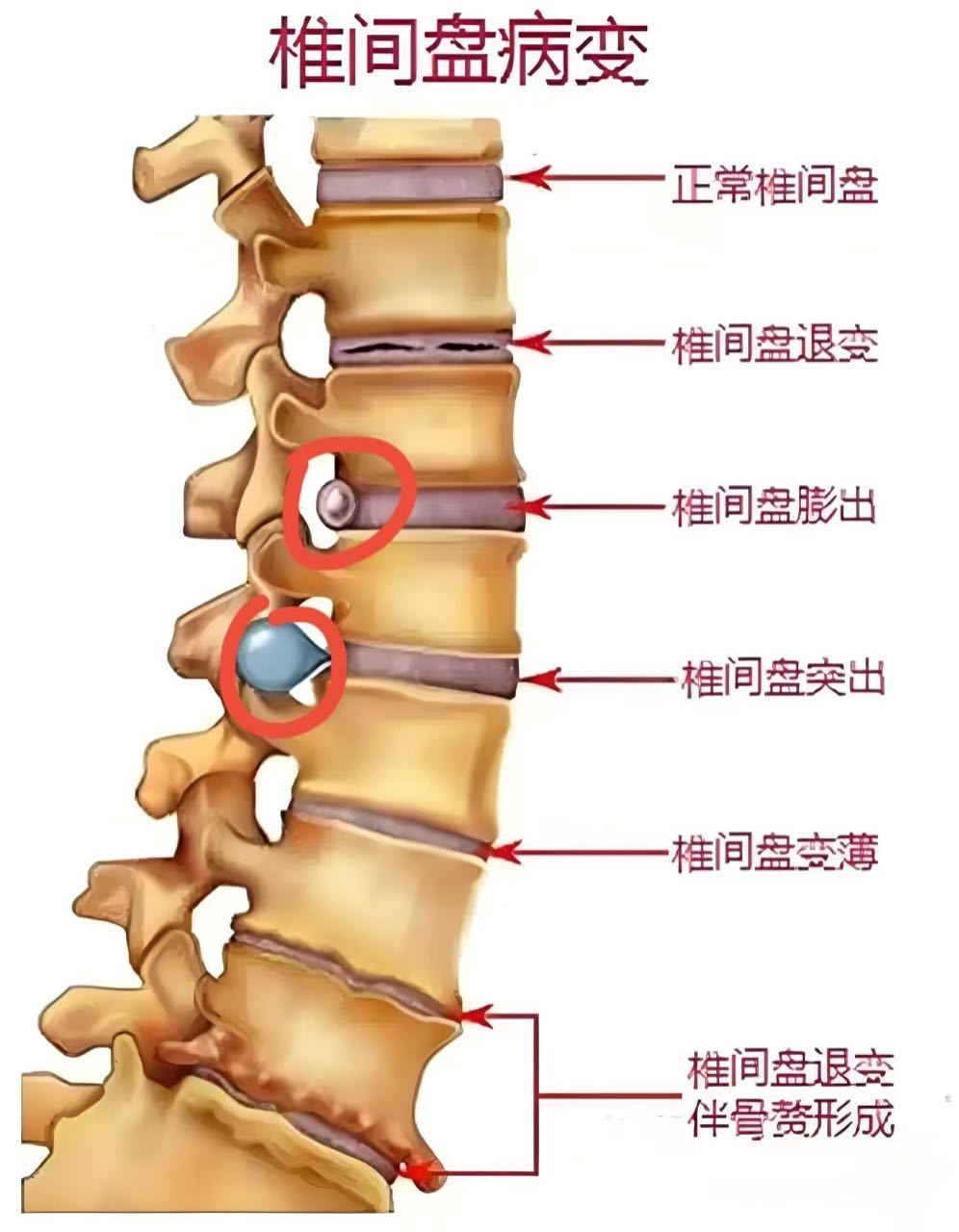 医学科普    椎间盘病变 ​​​