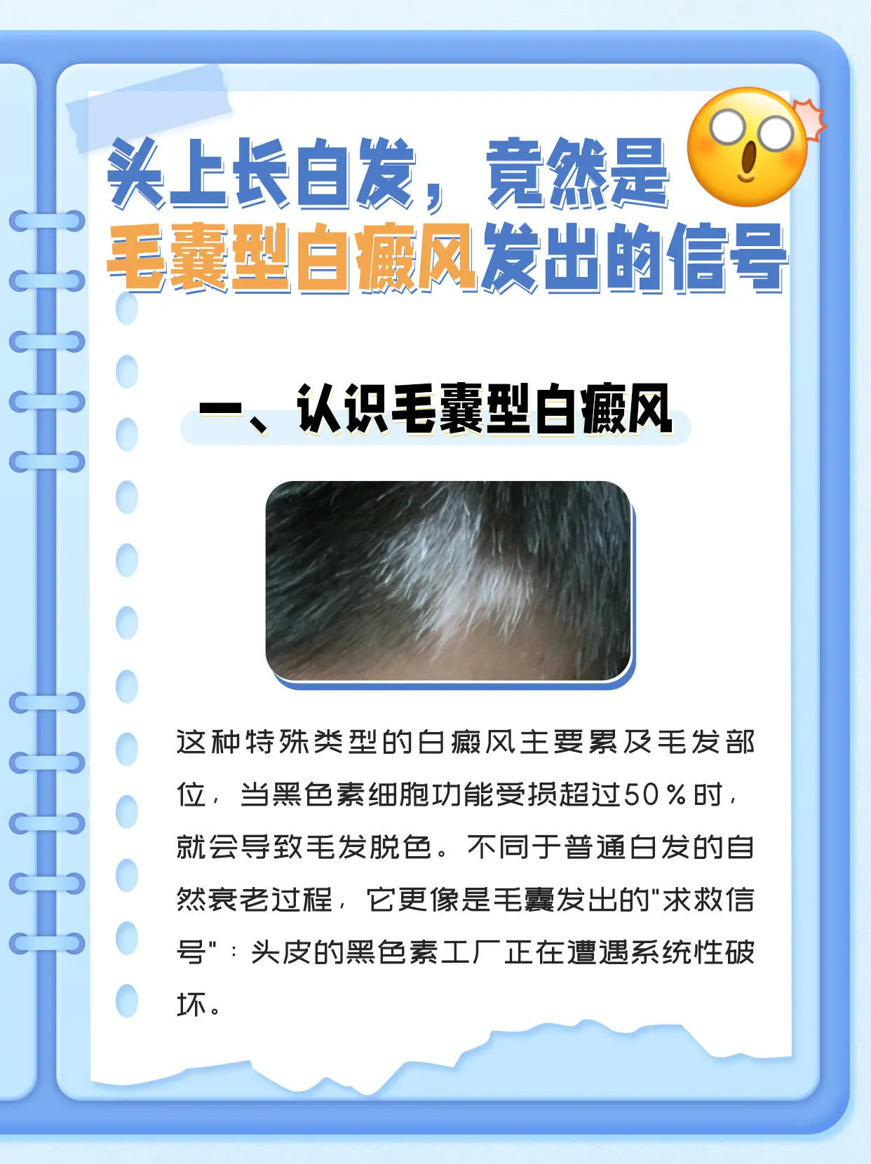 白癜风 白斑 白癜风患者