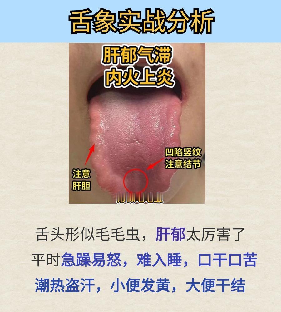 患者舌象实战分析----肝郁气滞，气滞血瘀，肾气不足